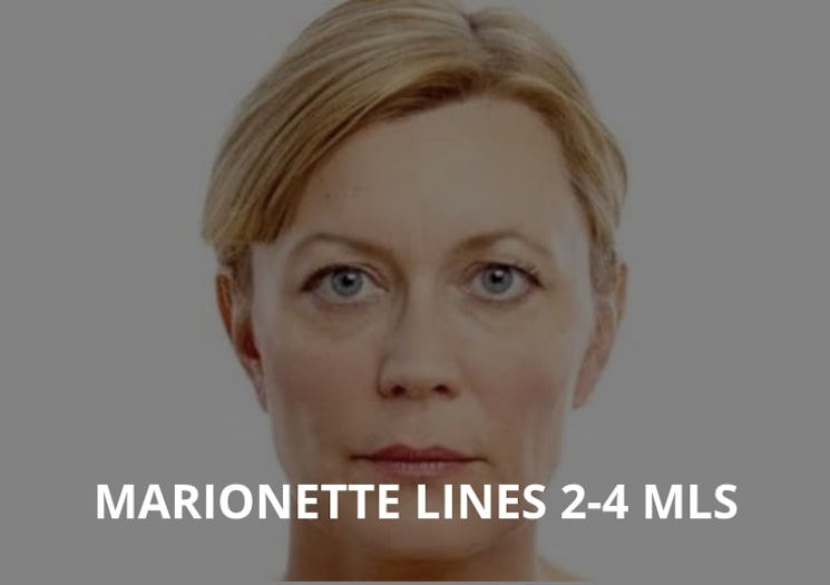 MARIONETTE LINES 2-4 MLS