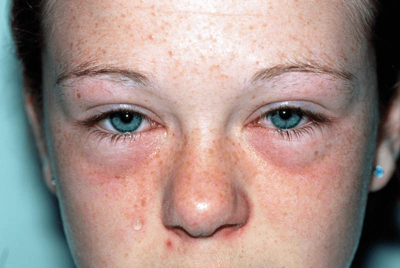 allergic rhinitis nasal treatment Sydney