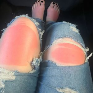 Sunburn through car window 