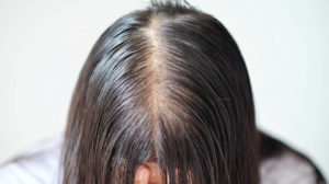 Hair Loss Treatment - Skin Essentials